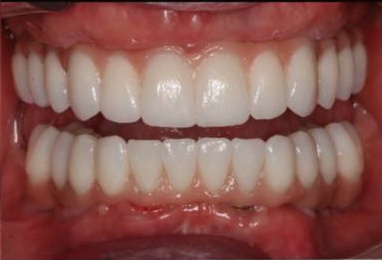teeth-after