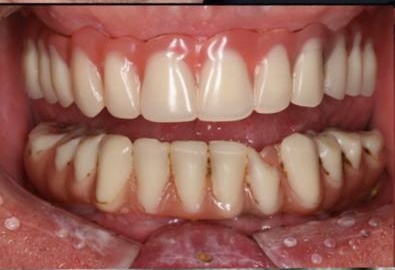 teeth-before